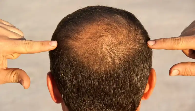 Saç Dökülmesi Neden Olur? Dikkat Edilmesi Gereken 5 Hastalık